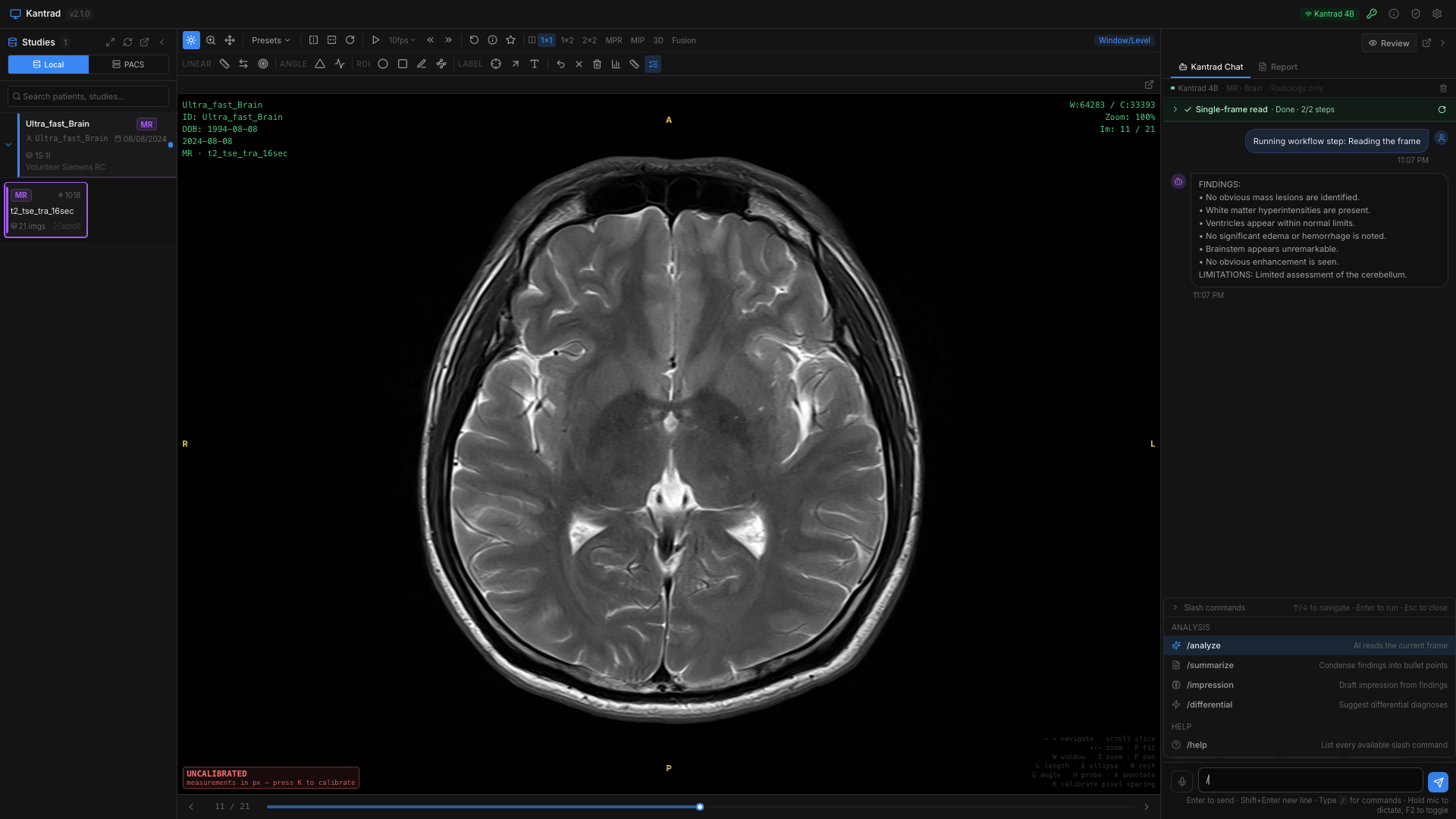 Kantrad workstation showing a CT study with annotations and a structured report